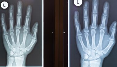 Do broken hamate bones sap player power?