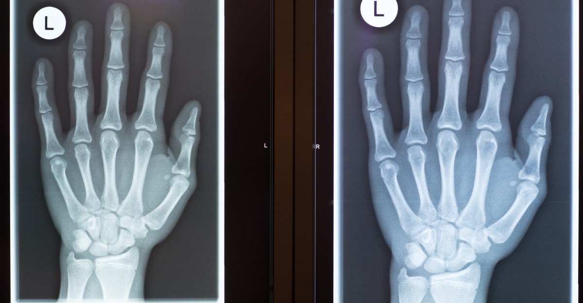 Do broken hamate bones sap player power?