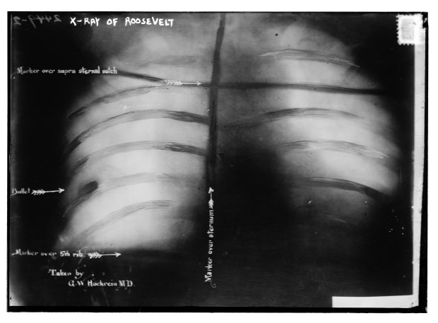 The X-ray of former President Theodore Roosevelt was taken shortly after he was shot on Oct. 14, 1912 by Bavarian immigrant John Schrank in Milwaukee. The bullet remained lodged in Roosevelt's body for the rest of his life. (Library of Congress)