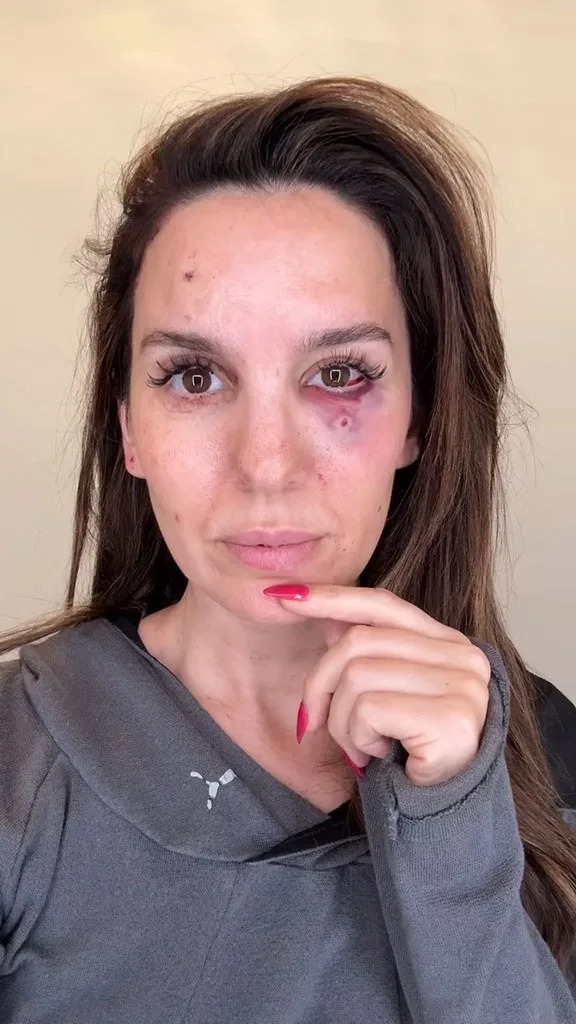<p>Christy Carlson Romano's Eye Injury</p>