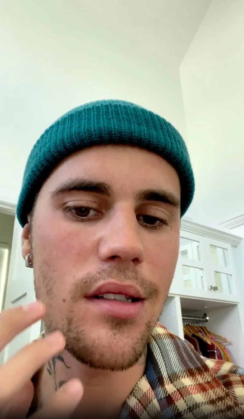 <p>Justin Bieber's Ramsay Hunt Syndrome</p>