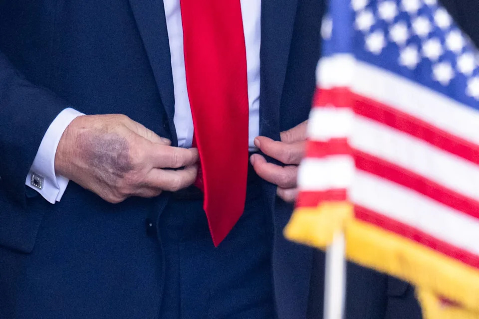 Trump has sported a dark bruise on the back of his right hand for over half a year. / Saul Loeb/Getty Images