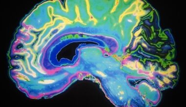 Subtle brain changes in football players could predict the risk of chronic traumatic encephalopathy