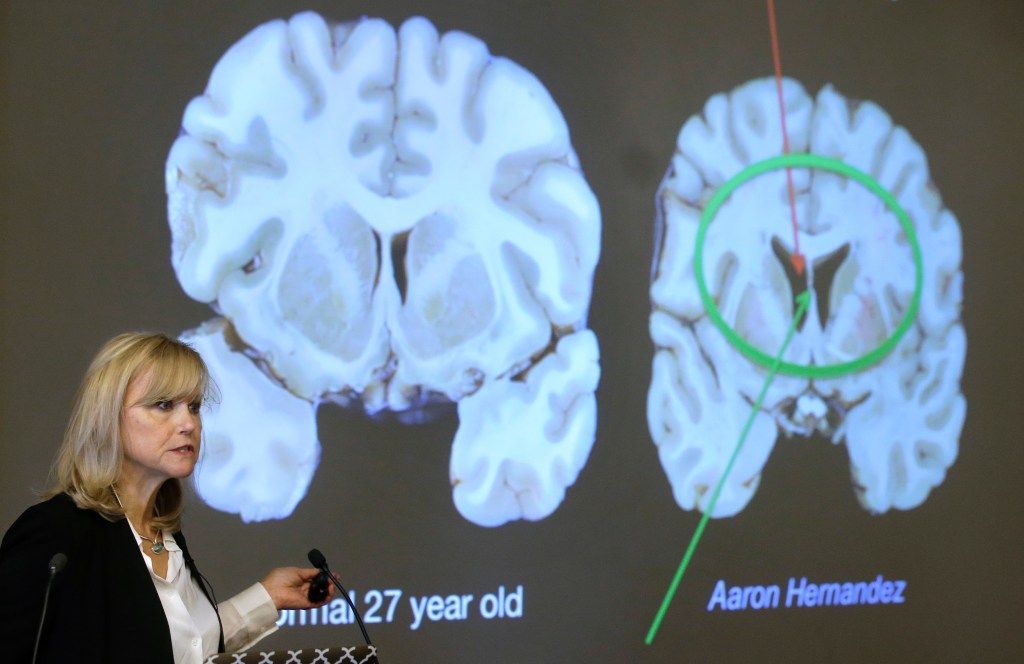 Ann McKee speaks next to a projection comparing the brain of a normal 27-year-old with the CTE-damaged brain of Aaron Hernandez.