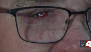 Dupo man gets Kansas City Chiefs-themed prosthetic eye after crash