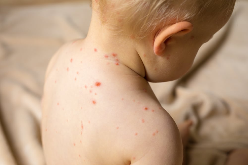 Manitoba issues blanket measles warning for 5 southern RMs, says fans were exposed at Jets game