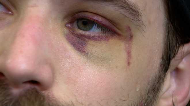 Stuart Skinner eye injury