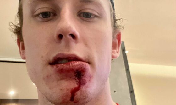 Allan Walsh on Twitter “Detroit forward Matt Luff took an 89 MPH slapshot off the chin last night against Minnesota, losing teeth and needing 16 stitches to repair the damage. He was on the ice for practice this morning.” #LuffIsTough