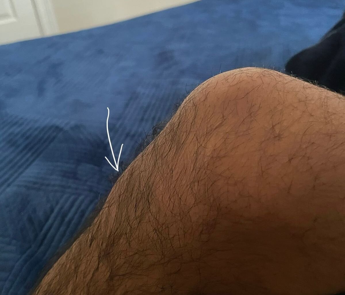 Pain after playing basketball