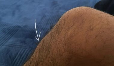 Pain after playing basketball