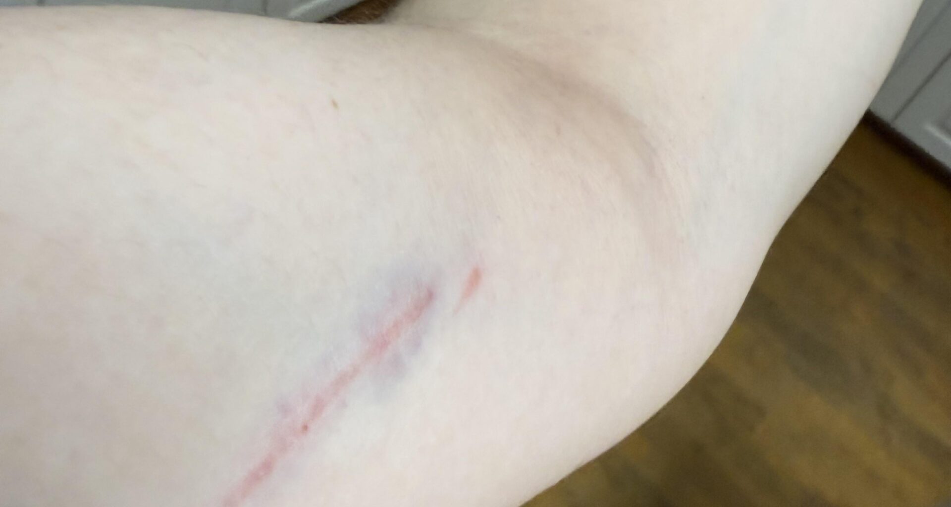 My dog scratched me, and the bruise looks like a Bills logo. Super Bowl confirmed.