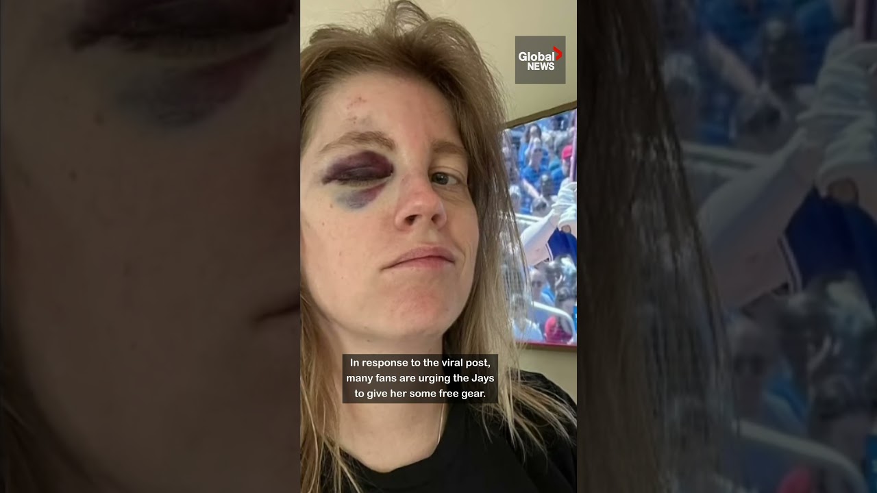 Toronto Blue Jays fan hit in face by 110mph foul ball ⚾🧢 #TO #baseball #BoBichette